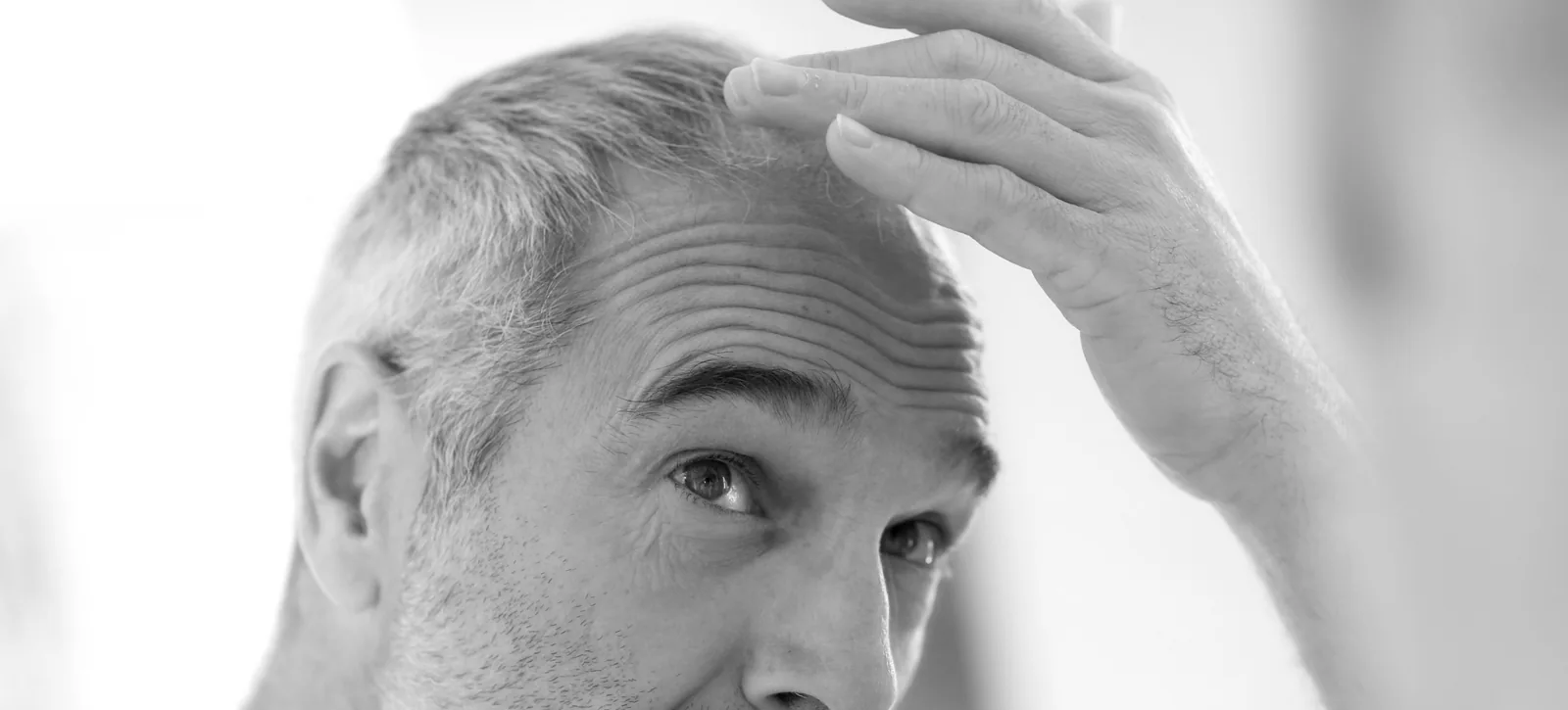 Homme examinant sa perte de cheveux, illustrant une greffe capillaire sans cicatrice réalisée par le Dr Pulvermacker à Paris