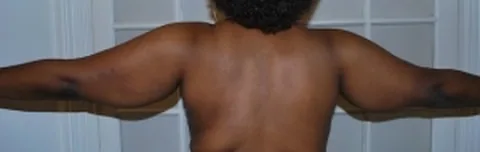 Lifting des bras - chirurgie esthétique Dr Pulvermacker, Paris
