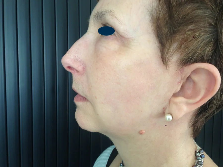 Lifting Visage et Cou