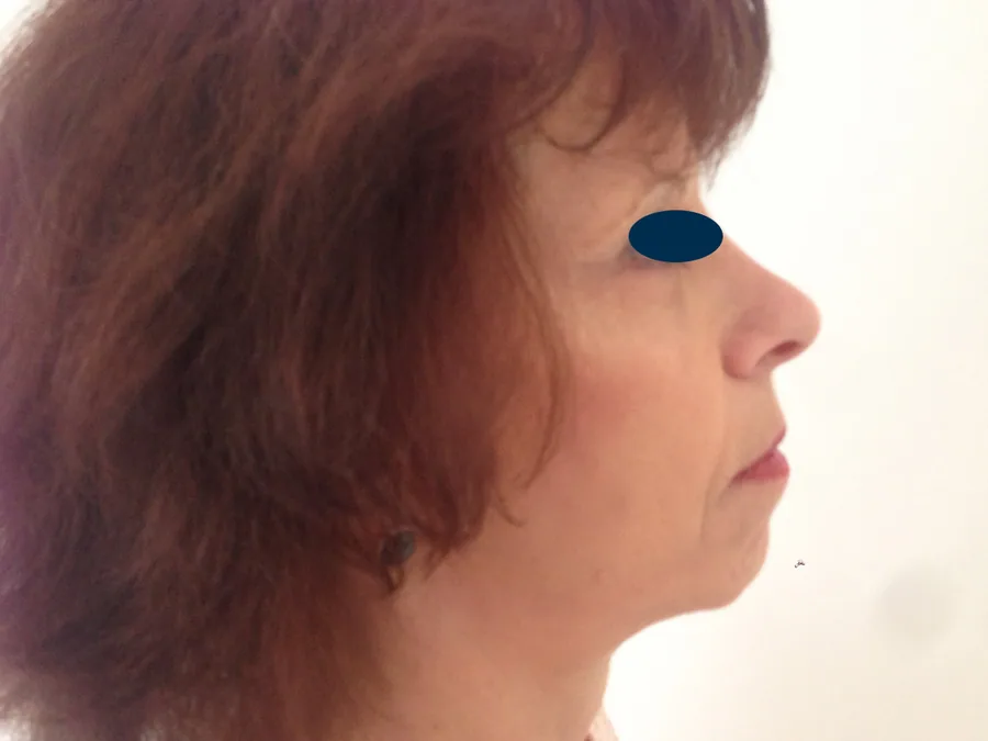 Lifting Visage et Cou