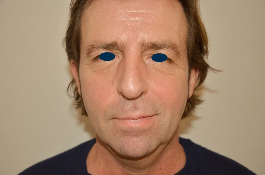 Lifting Visage et Cou