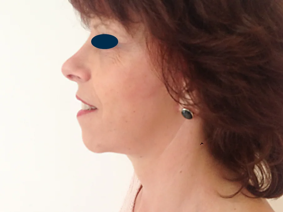 Lifting Visage et Cou