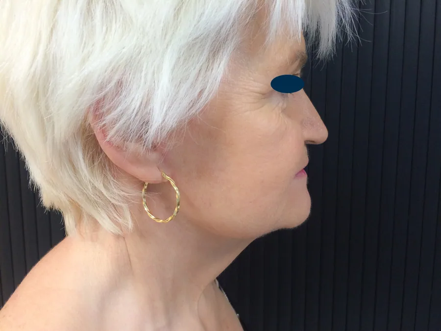 Lifting Visage et Cou