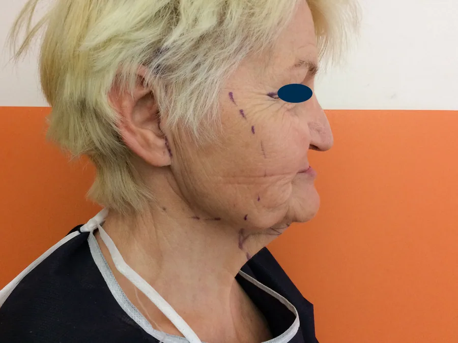 Lifting Visage et Cou