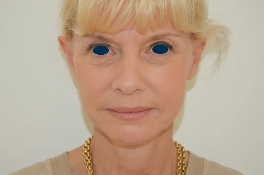 Lifting Visage et Cou