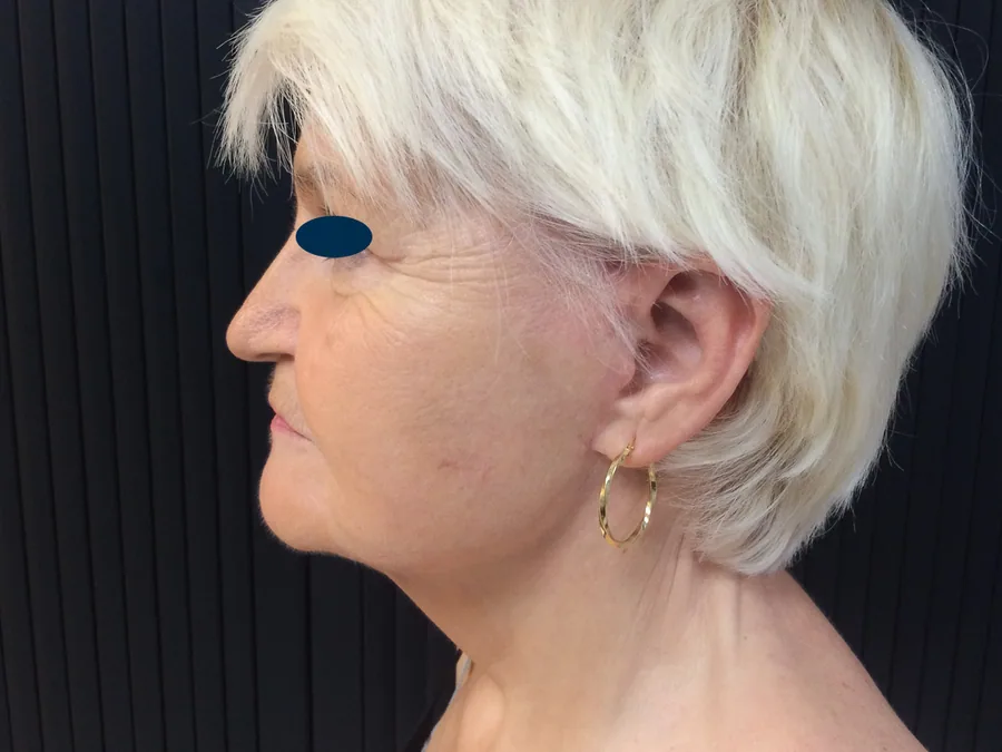 Lifting Visage et Cou