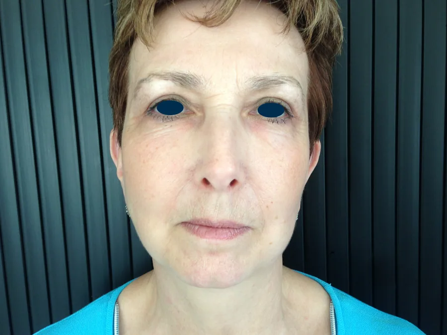 Lifting Visage et Cou