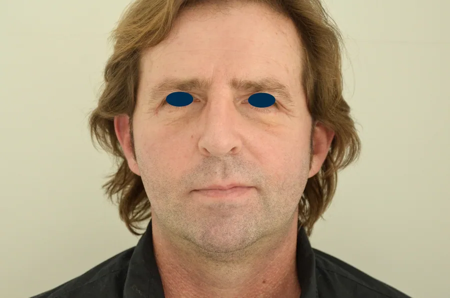 Lifting Visage et Cou