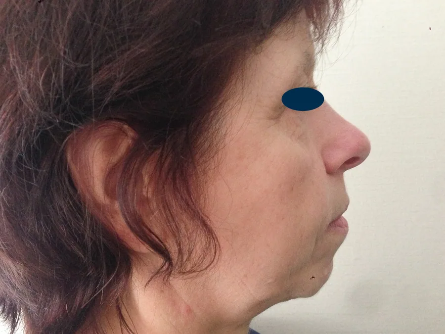 Lifting Visage et Cou