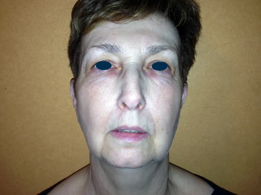 Lifting Visage et Cou
