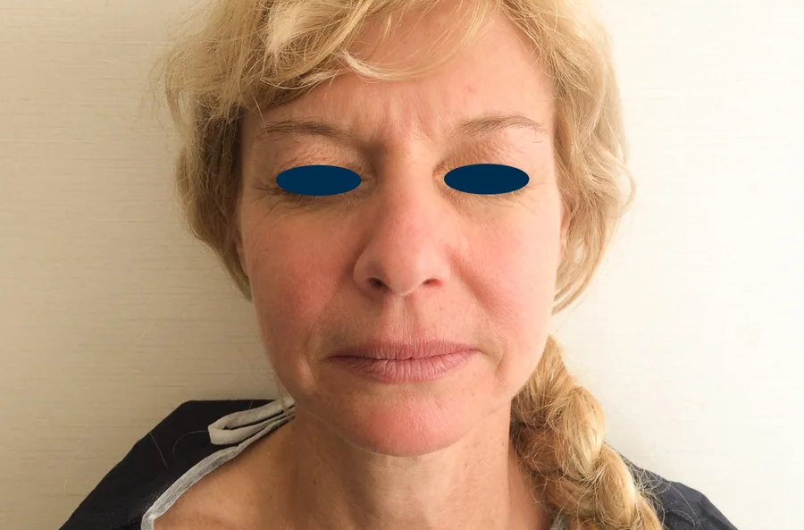 Lifting Visage et Cou Avant