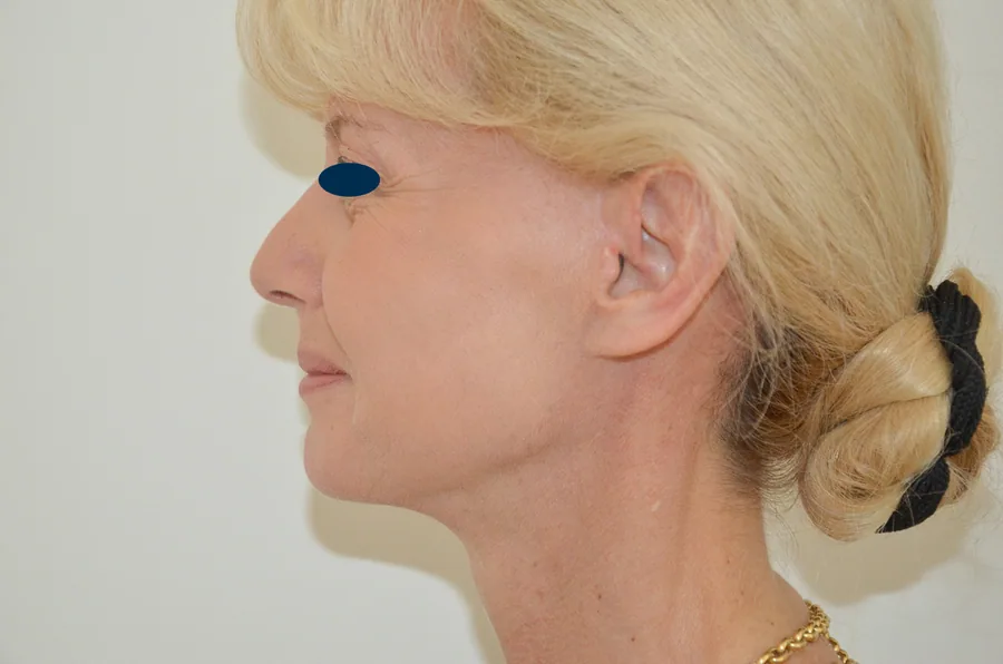 Lifting Visage et Cou