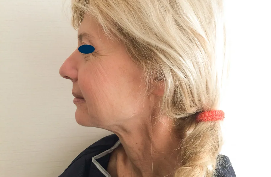 Lifting Visage et Cou