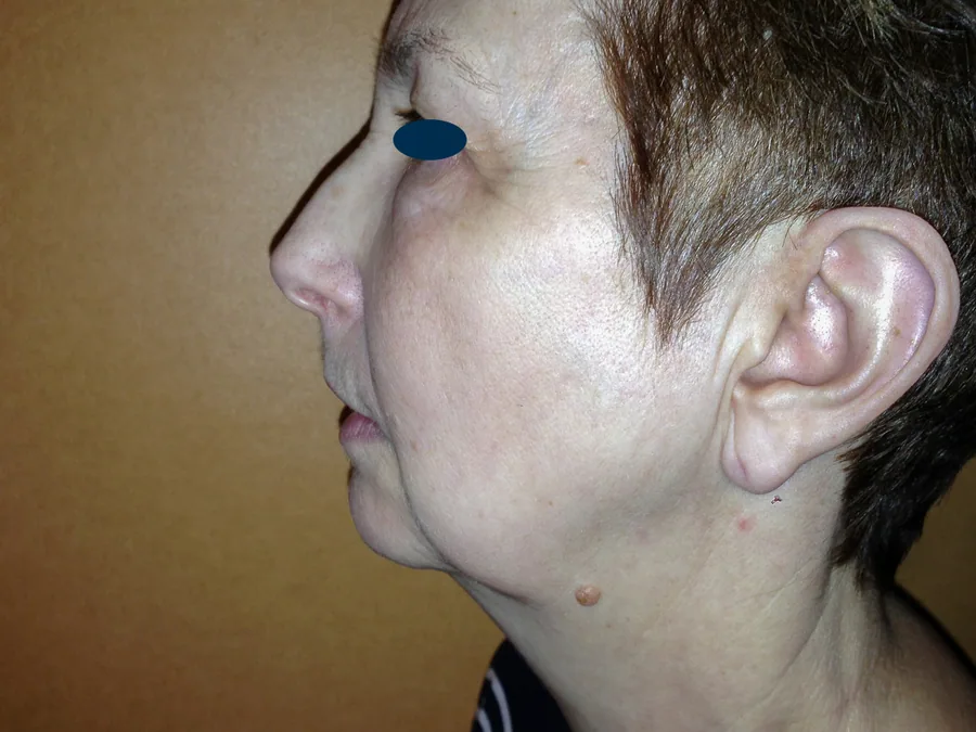 Lifting Visage et Cou