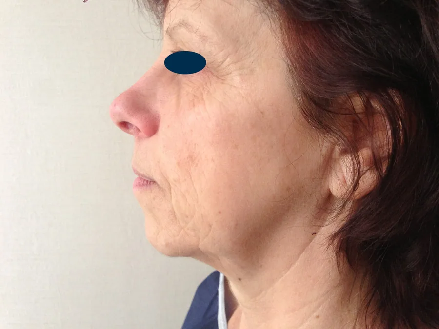 Lifting Visage et Cou