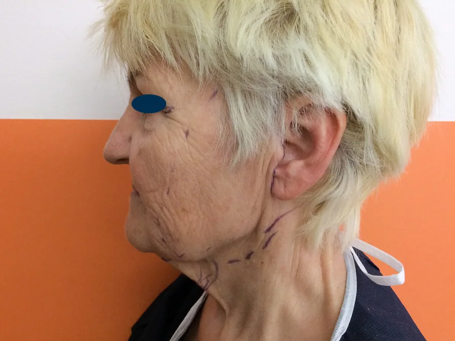 Lifting Visage et Cou