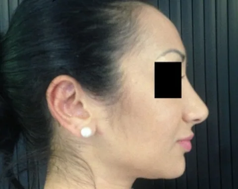 Patiente après rhinoplastie - Dr Pulvermacker, Paris