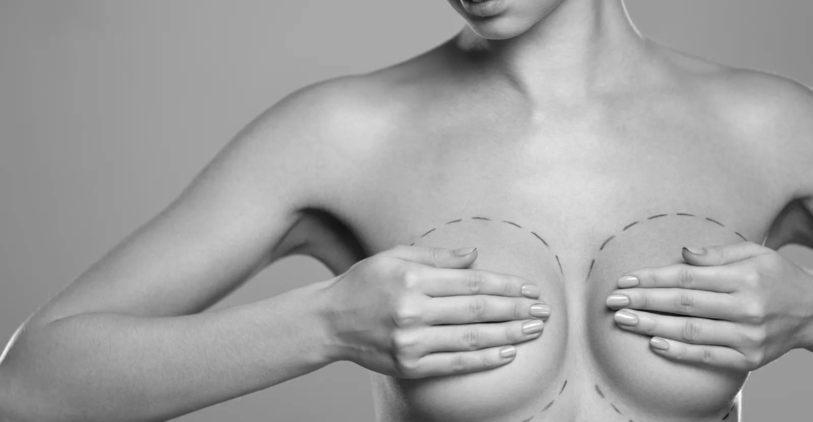 Patiente présentant des repères de marquage chirurgical sur la poitrine, illustrant une réduction mammaire réalisée par le Dr Pulvermacker à Paris