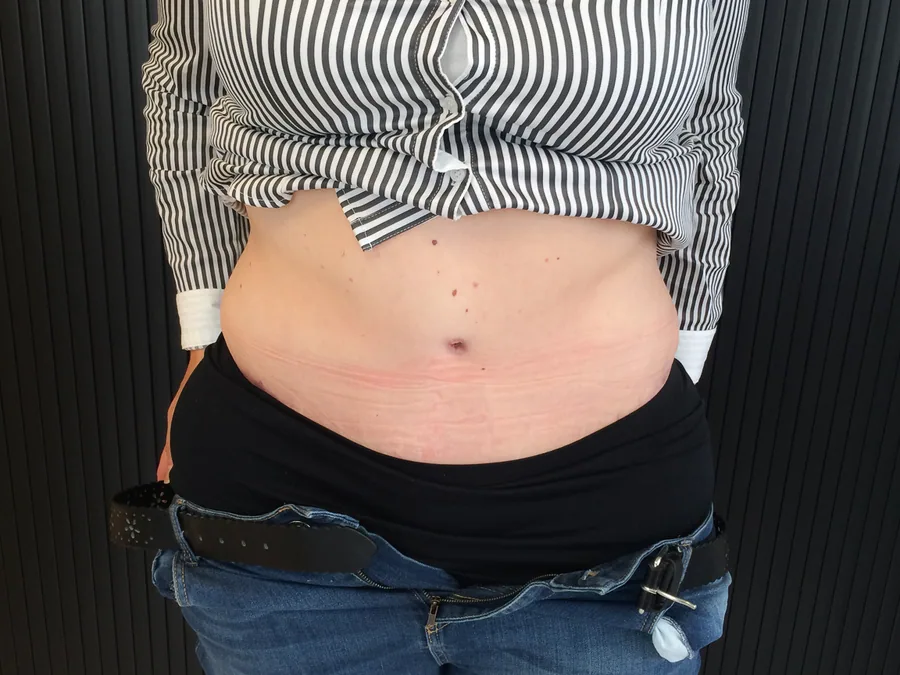 Photo après abdominoplastie - Dr Pulvermacker, Paris