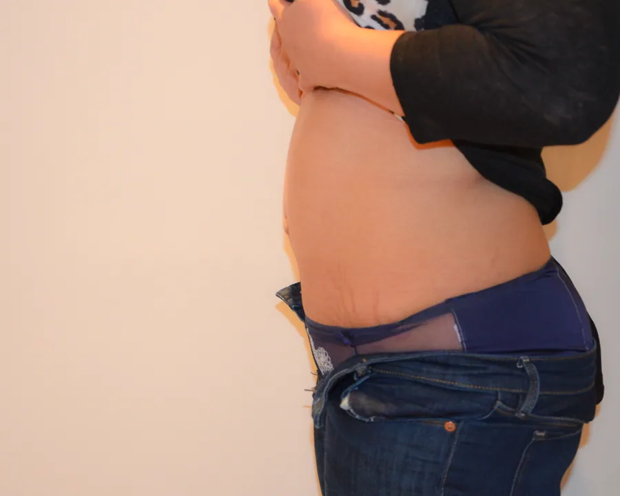 Photo après abdominoplastie - Dr Pulvermacker, Paris