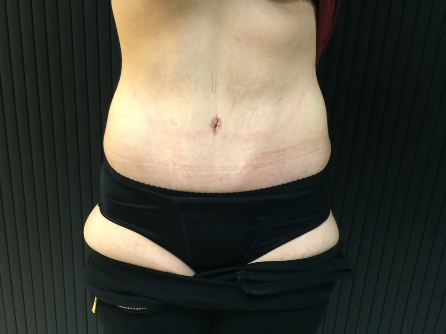 Photo après abdominoplastie - Dr Pulvermacker, Paris