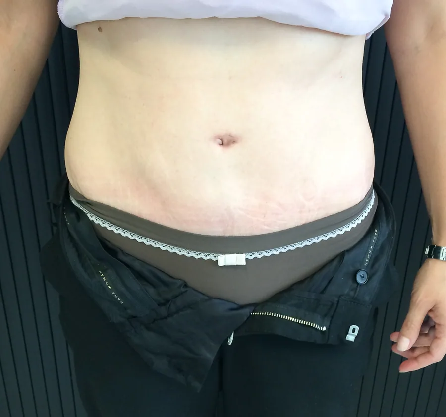 Photo après abdominoplastie - Dr Pulvermacker, Paris