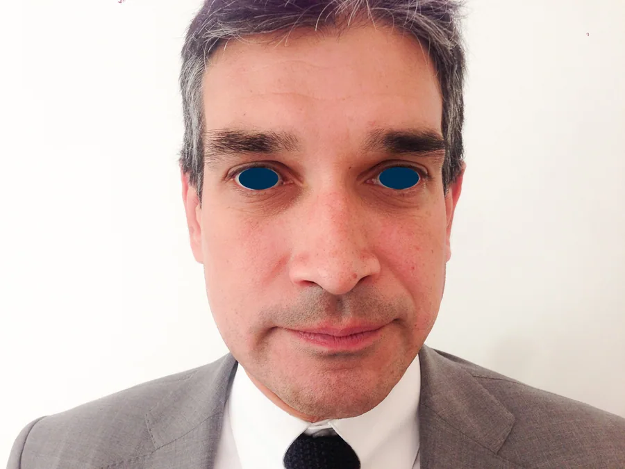 Photo après chirurgie des oreilles - Dr Pulvermacker, Paris