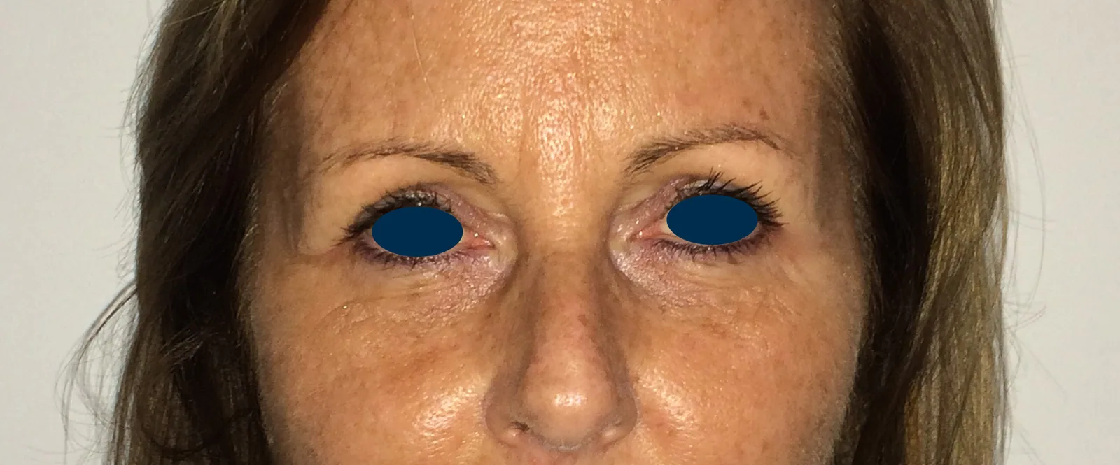 Photo après chirurgie des paupières - Dr Pulvermacker, Paris
