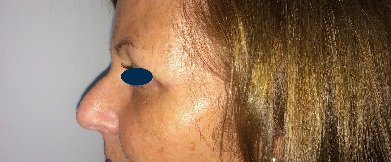 Photo après chirurgie des paupières - Dr Pulvermacker, Paris