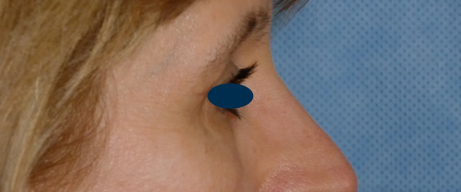 Photo après chirurgie des paupières - Dr Pulvermacker, Paris
