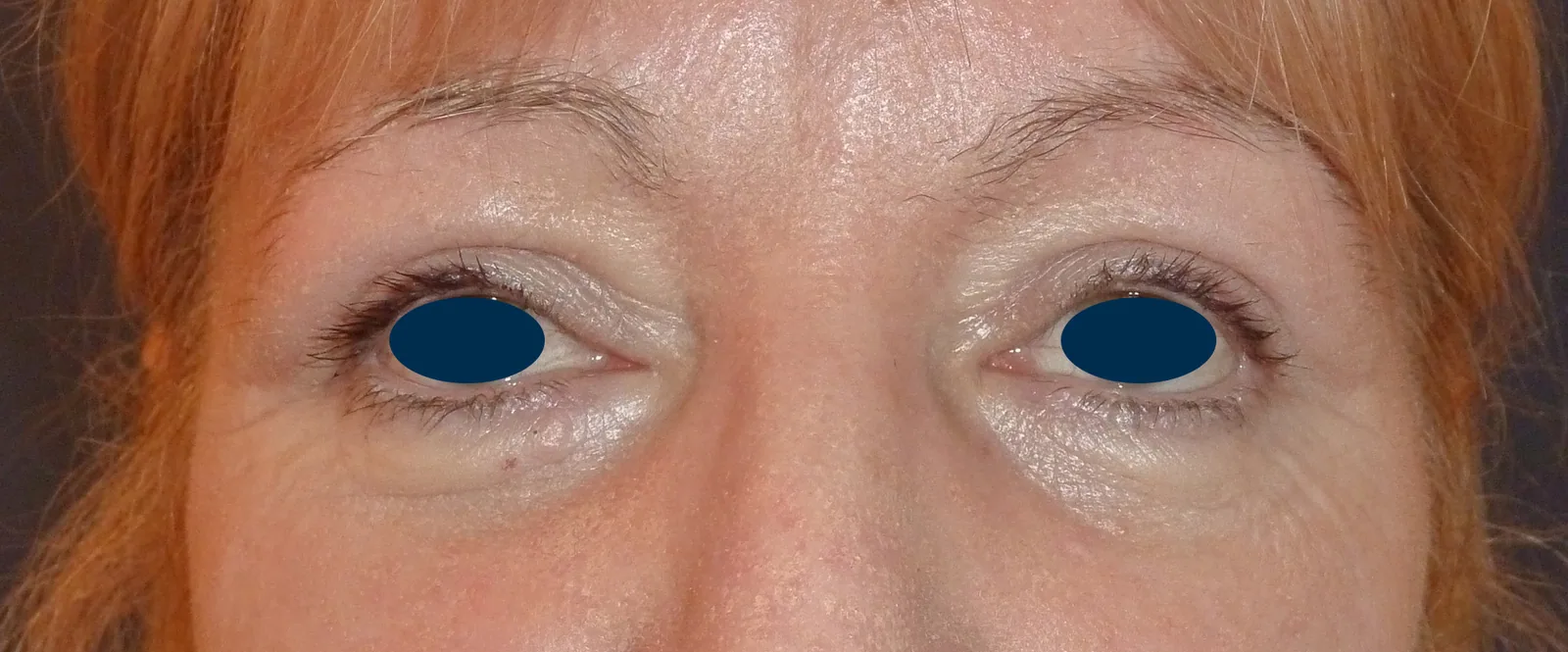 Photo après chirurgie des paupières - Dr Pulvermacker, Paris