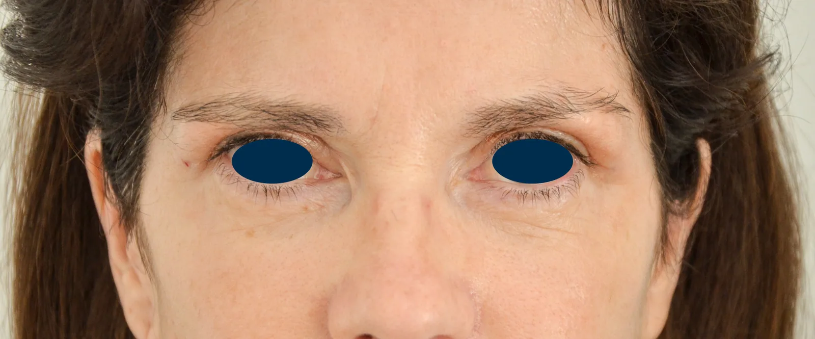 Photo après chirurgie des paupières - Dr Pulvermacker, Paris