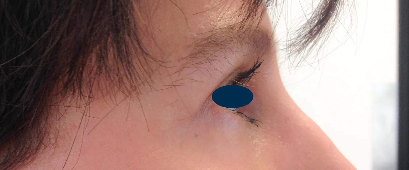Photo après chirurgie des paupières - Dr Pulvermacker, Paris
