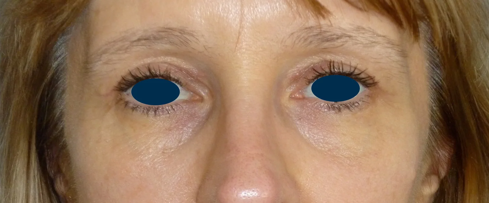 Photo après chirurgie des paupières - Dr Pulvermacker, Paris
