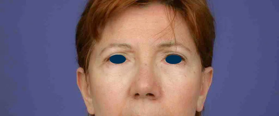 Photo après chirurgie des paupières - Dr Pulvermacker, Paris