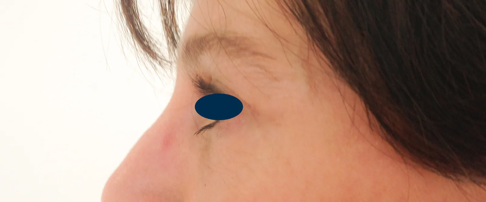 Photo après chirurgie des paupières - Dr Pulvermacker, Paris