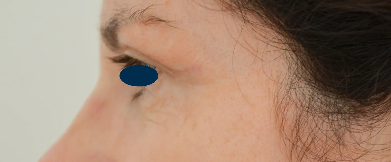 Photo après chirurgie des paupières - Dr Pulvermacker, Paris