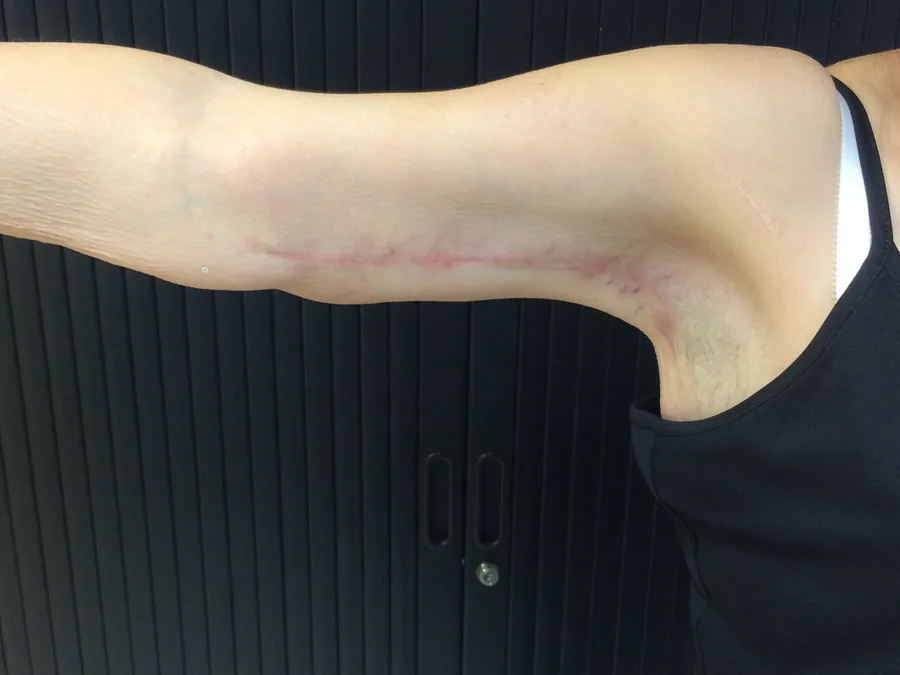 Photo après lifting des bras - Dr Pulvermacker, Paris