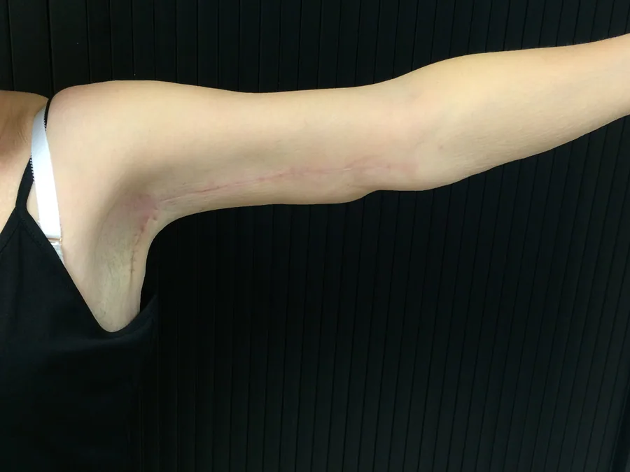 Photo après lifting des bras - Dr Pulvermacker, Paris