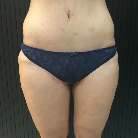 Photo après lifting des cuisses - Dr Pulvermacker, Paris
