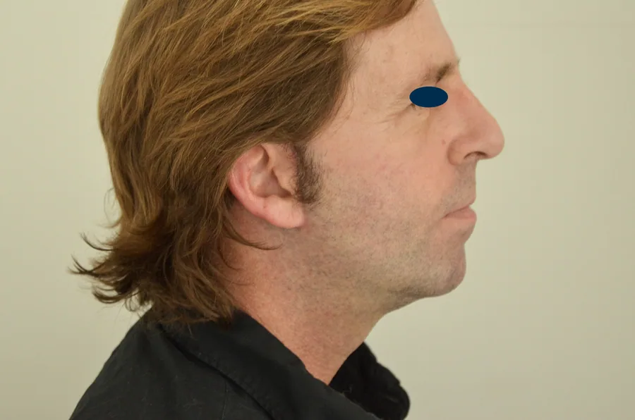 Photo après lifting du visage - Dr Pulvermacker, Paris