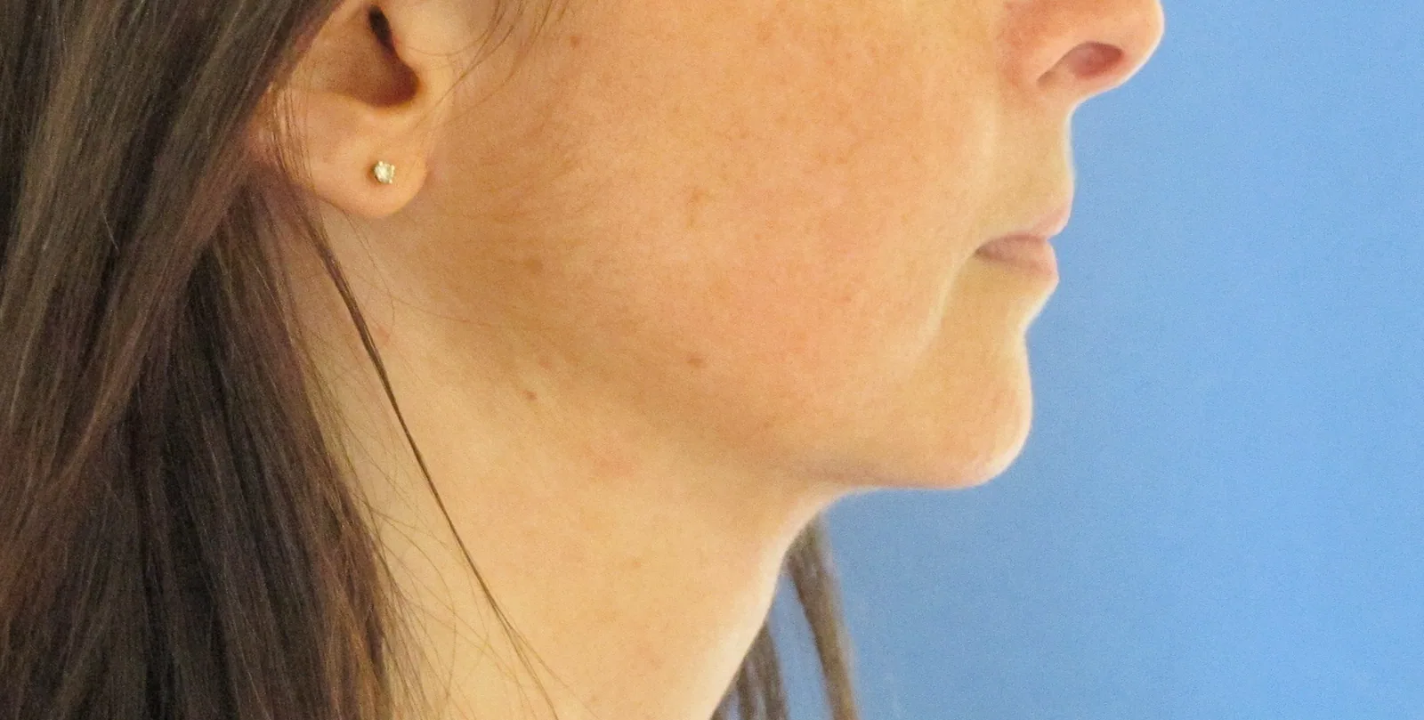 Photo après lifting du visage - Dr Pulvermacker, Paris