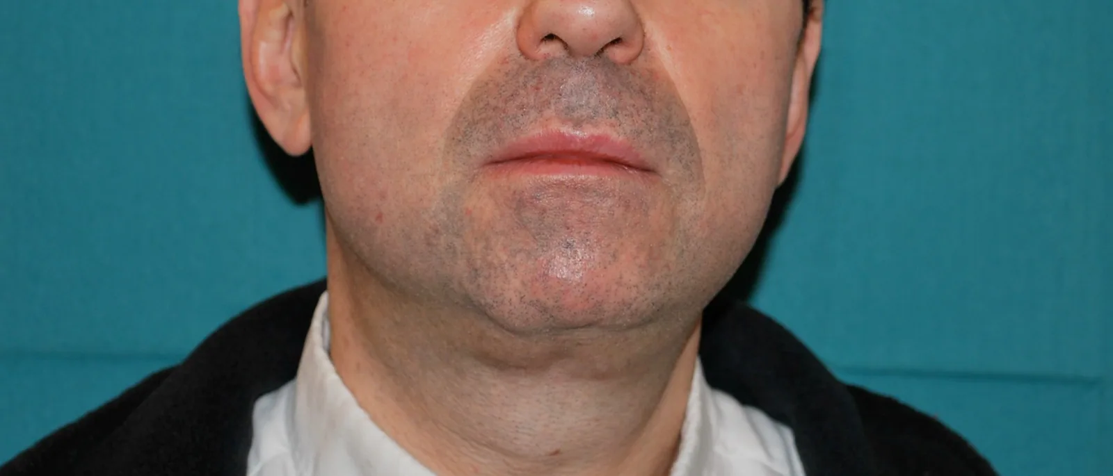 Photo après lifting du visage - Dr Pulvermacker, Paris