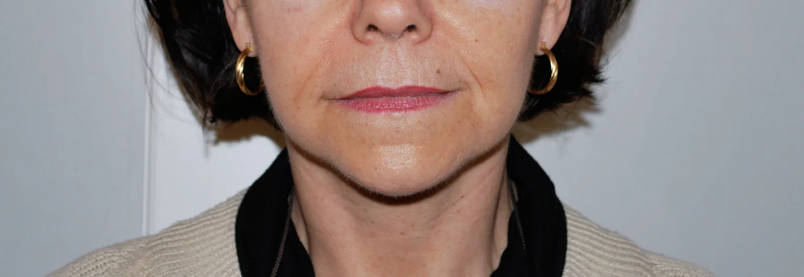 Photo après lifting du visage - Dr Pulvermacker, Paris