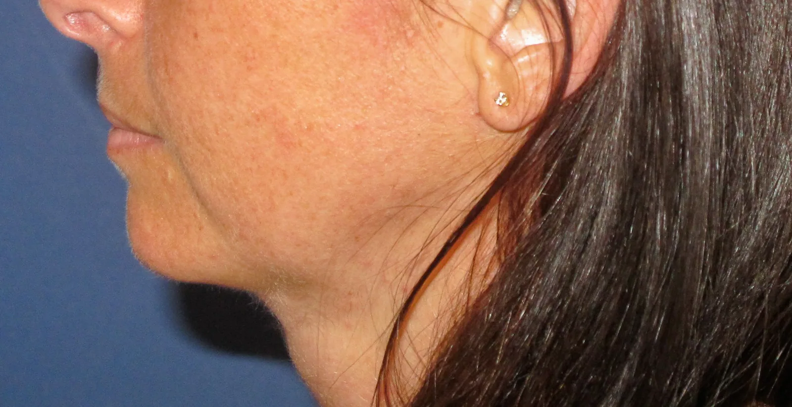 Photo après lifting du visage - Dr Pulvermacker, Paris
