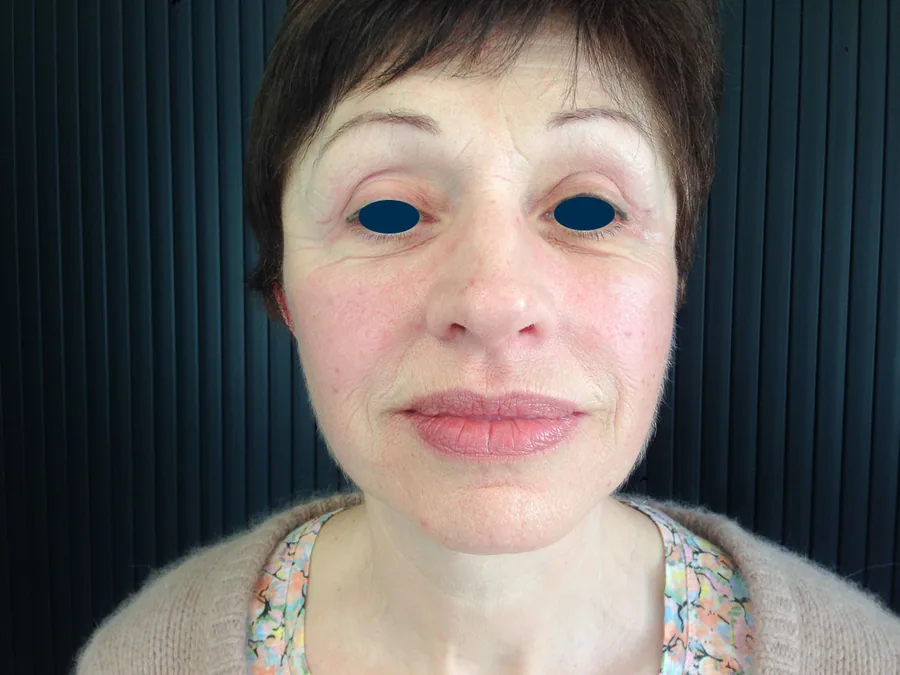 Photo après lifting du visage - Dr Pulvermacker, Paris