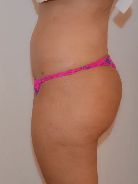 Photo après lipostructure - Dr Pulvermacker, Paris