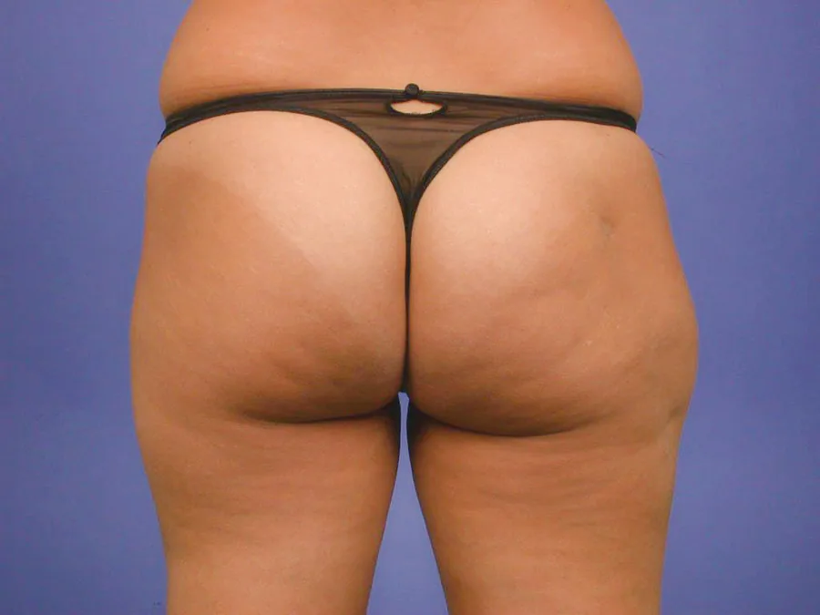 Photo après lipostructure - Dr Pulvermacker, Paris