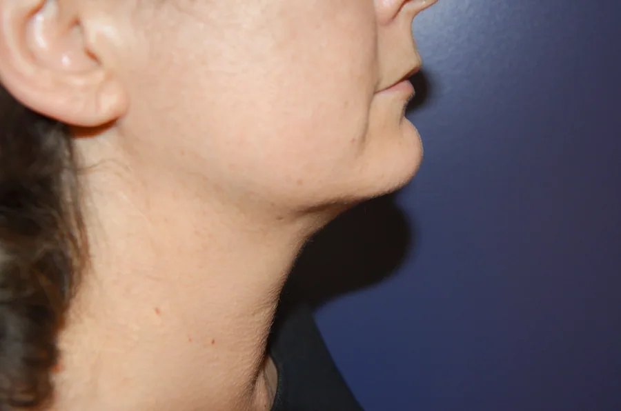 Photo après liposuccion du cou - Dr Pulvermacker, Paris