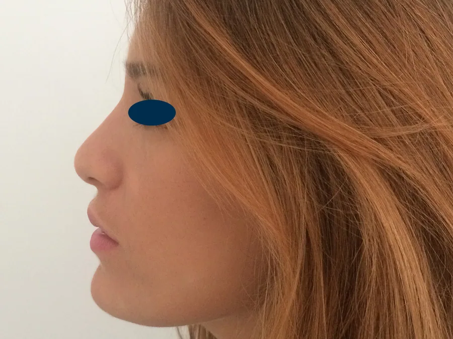 Photo après rhinoplastie - Dr Pulvermacker, Paris